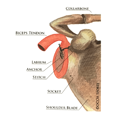 Shoulder Labrum Repair